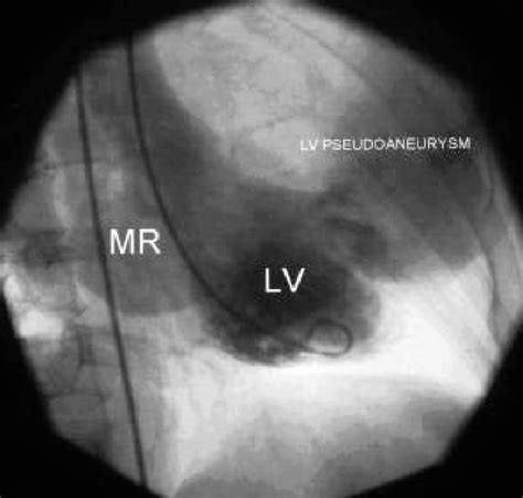 lv ventriculogram